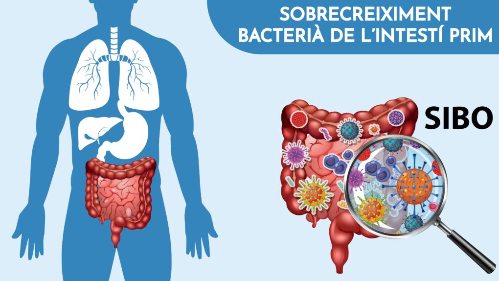 SIBO (sobrecreiximent bacterià de l'intestí prim)