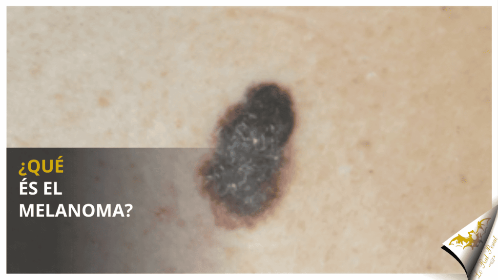 ¿Qué és el melanoma?