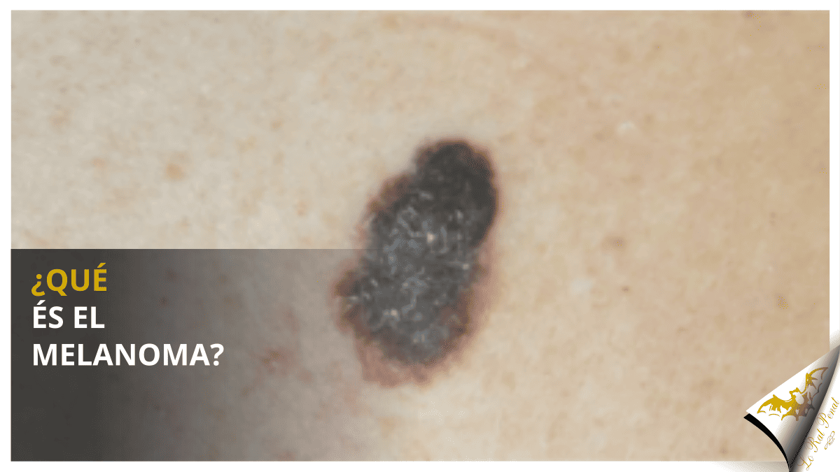 ¿Qué és el melanoma?