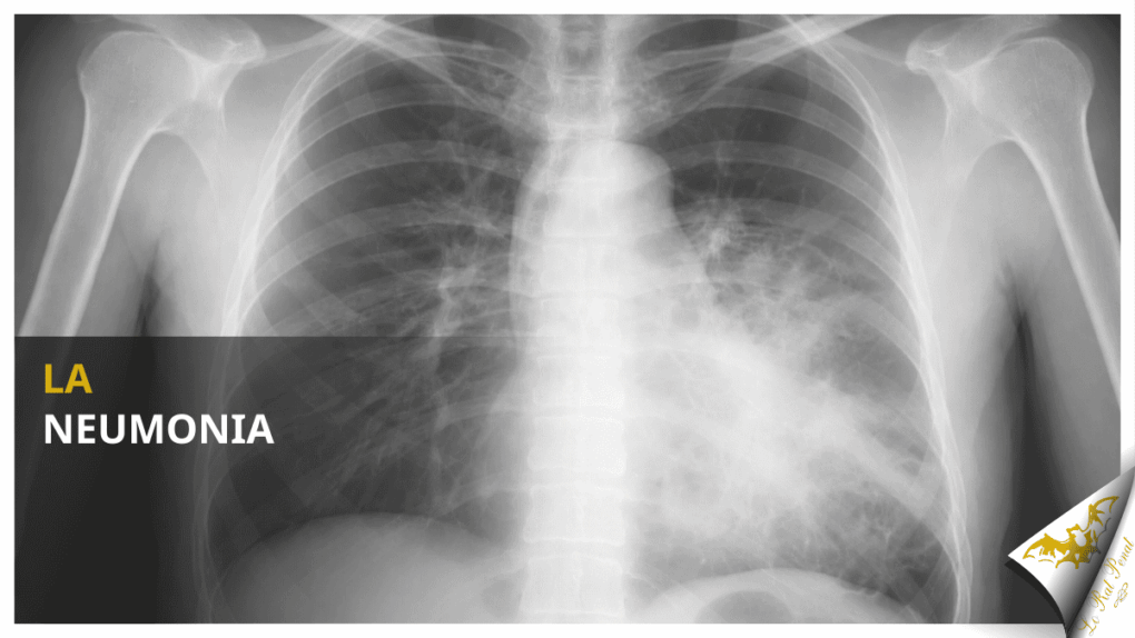La neumonia