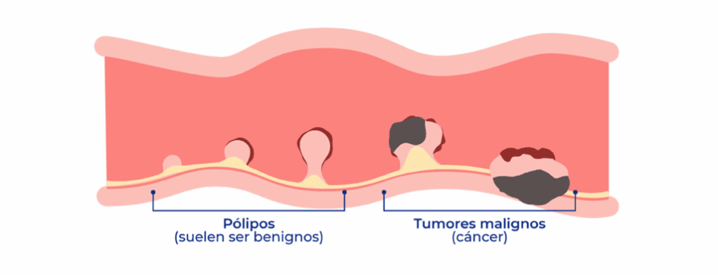 Tipos de pòlips de colon