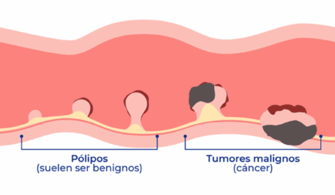 Tipos de pòlips de colon