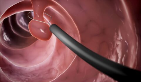 Eliminació de pòlip de colon: polipectomia