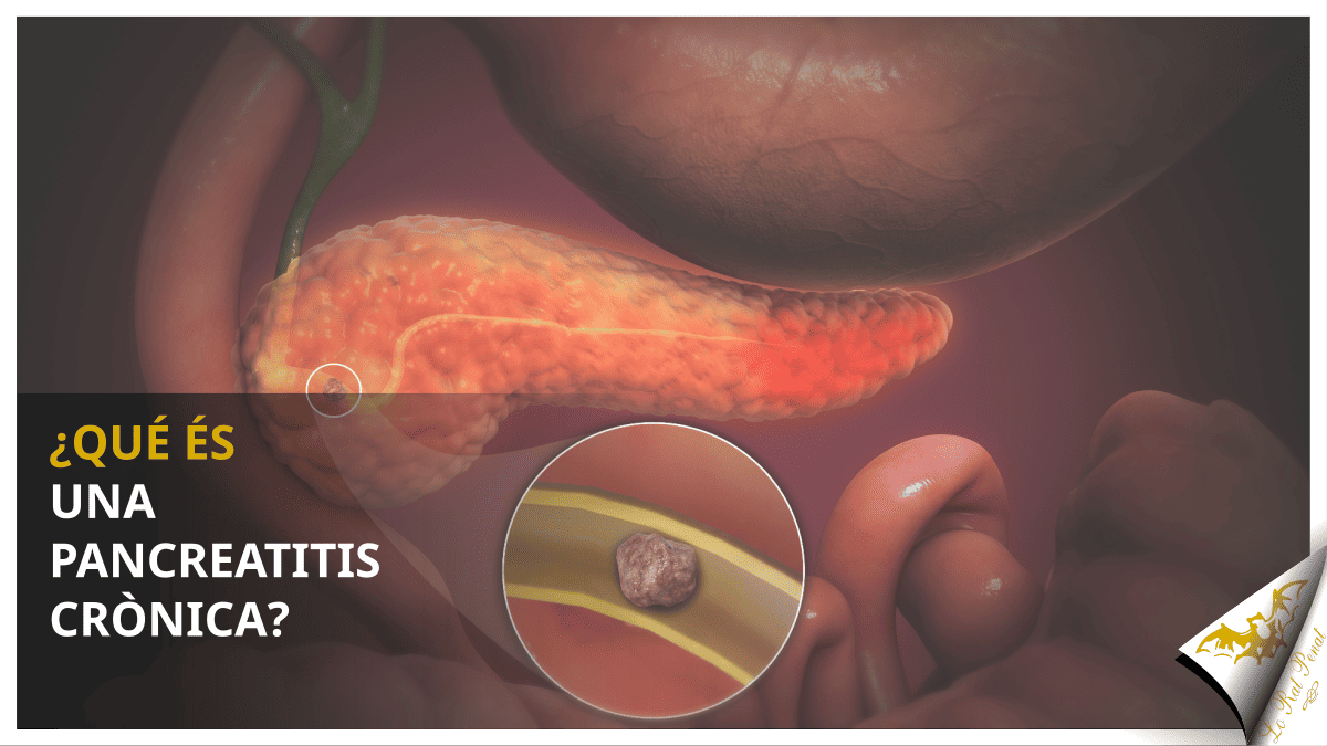 ¿Qué és una pancreatitis crònica?